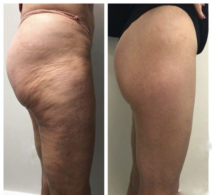 DEVELOPMENT OF CELLULITE